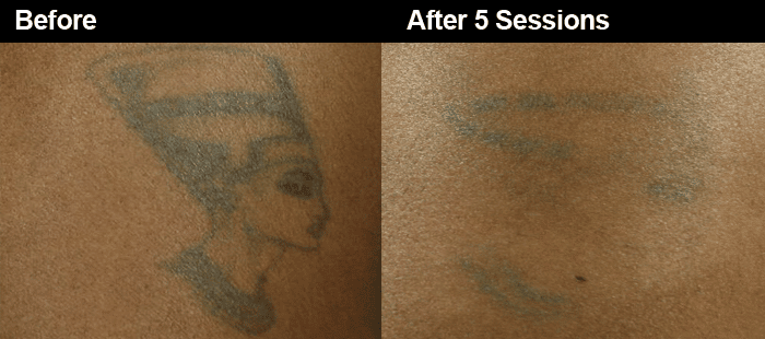 Laser Tattoo Removal Is Safe For Dark Skin? Safety is Our Top Priority