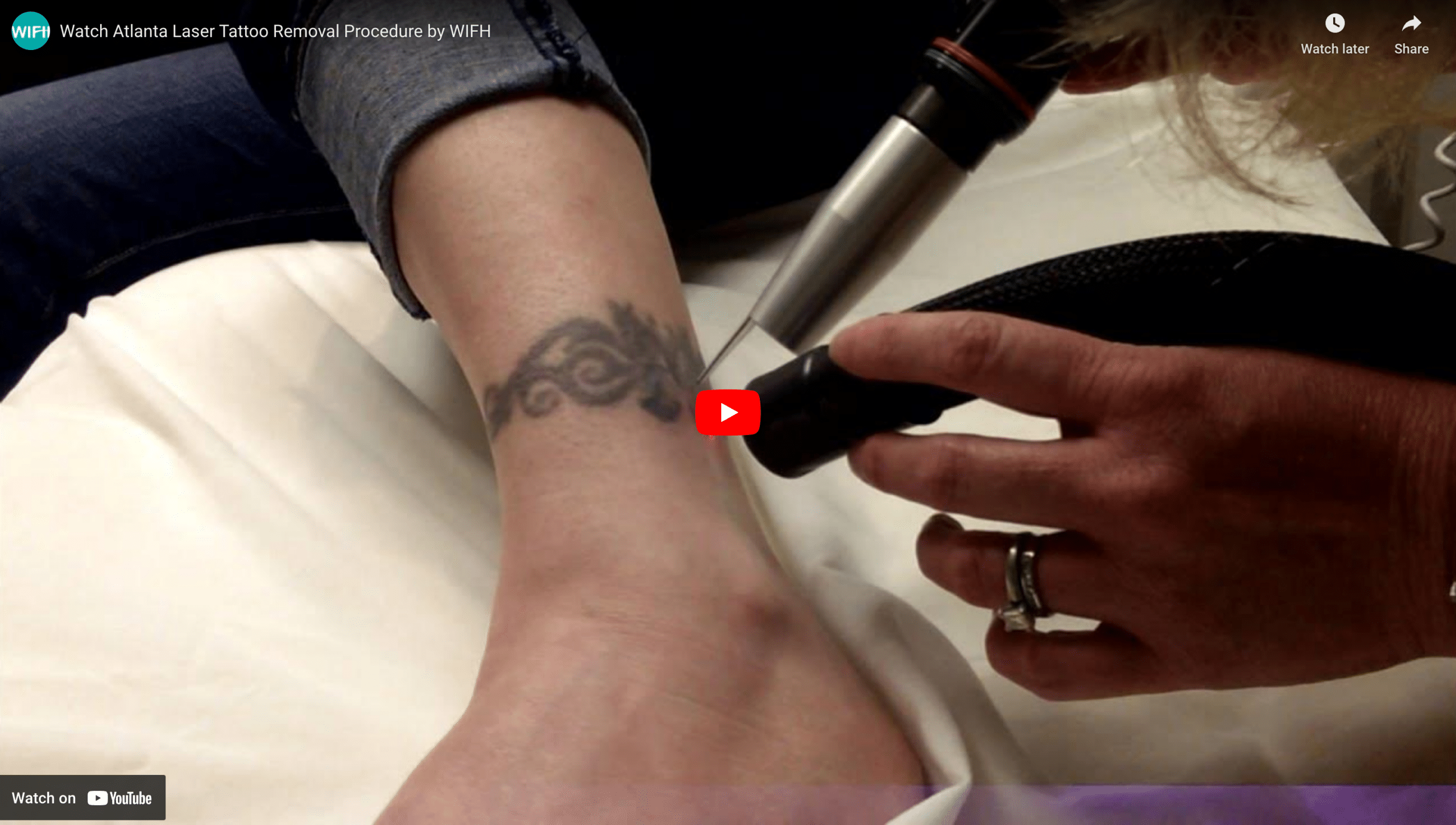 Watch Laser Tattoo Removal Video