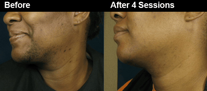 Atlanta Male Laser Hair Removal for Men