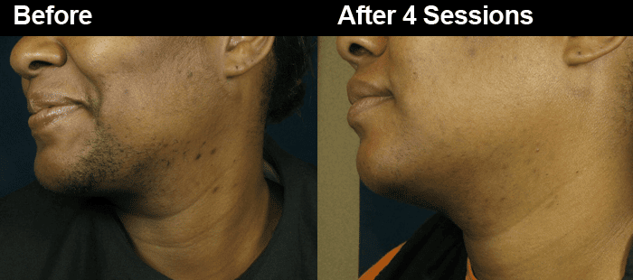 Ingrown facial hair black women