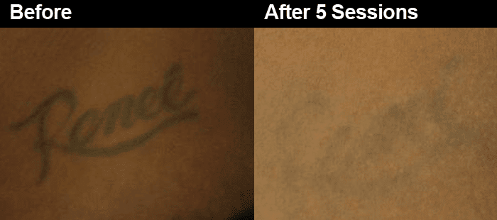 Laser tattoo removal How it works how long it takes and side effects   Metro News