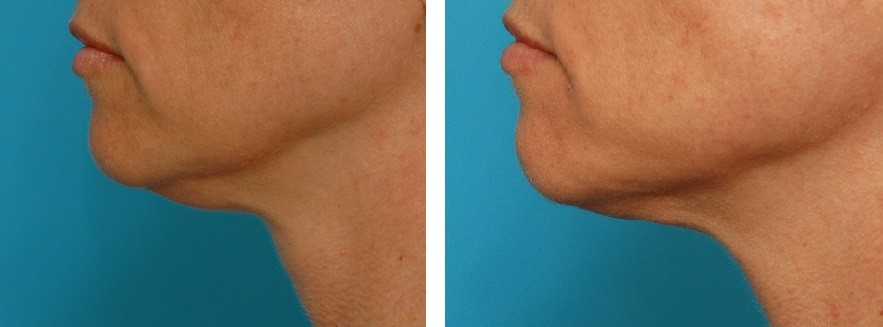 double chin liposuction before and after photos