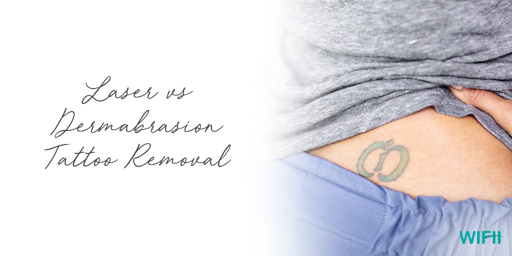 Laser vs. Dermabrasion Tattoo Removal