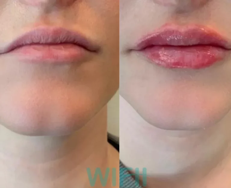 Injectables in Atlanta - Before and After photos