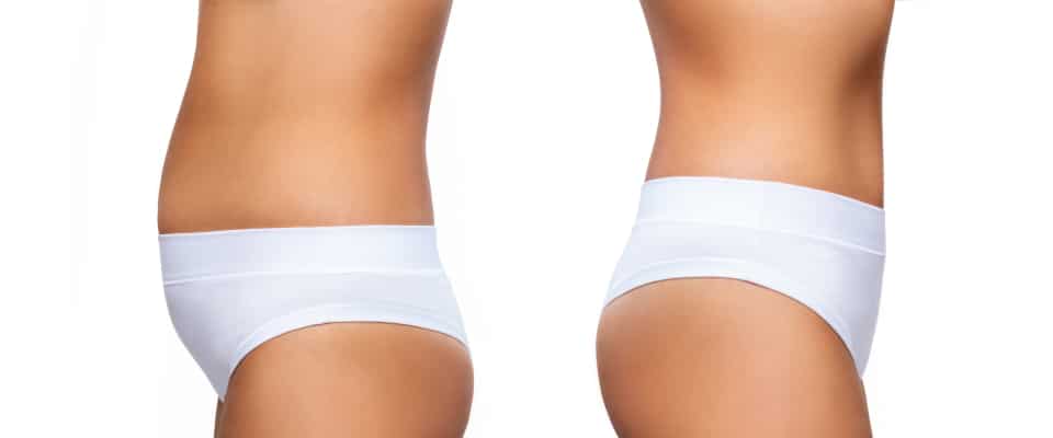 A Patient's Guide to Getting 360 Lipo in Atlanta