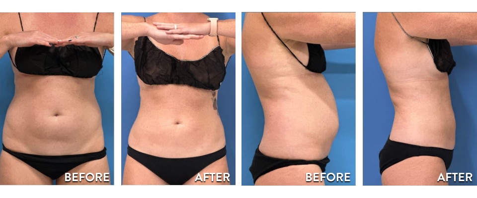 What Is Lipo 360?