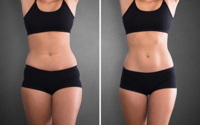 SmartLipo: An Alternative to a Tummy Tuck or Not?