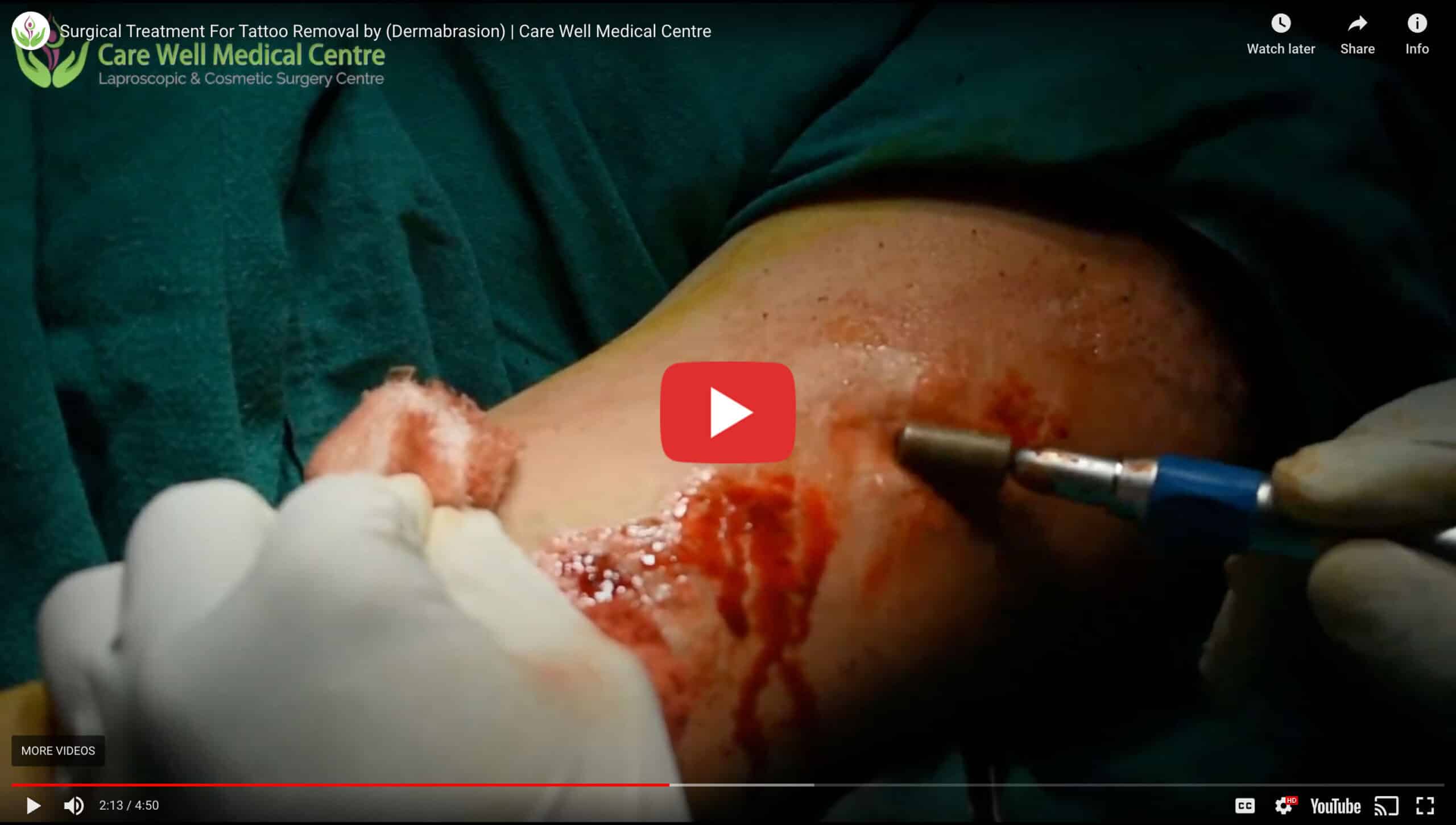 Watch a Dermabrasion Tattoo Removal Procedure