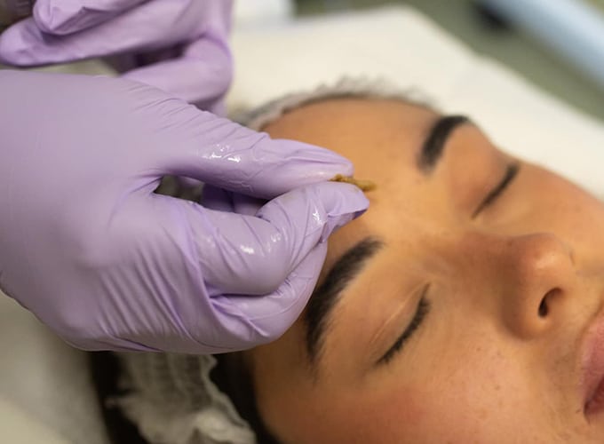 About Chemical Peels