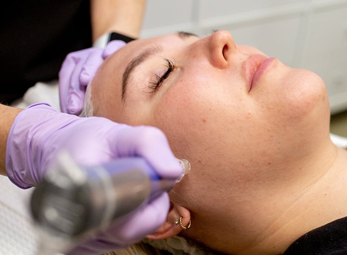 How Does Microneedling Work