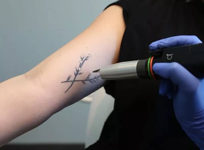 Laser Tattoo Removal Recovery Time​