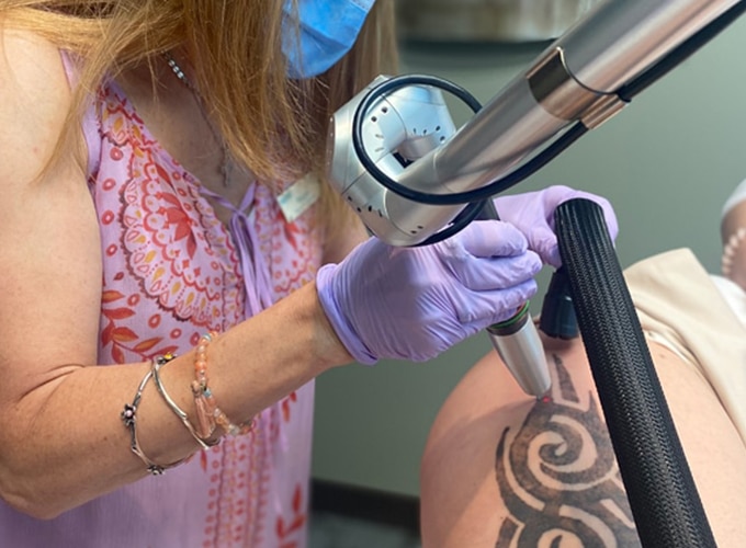 What Is Laser Tattoo Removal