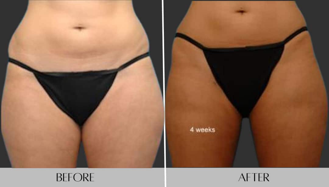 Inner Thigh Liposuction in Atlanta | Before & After Picture