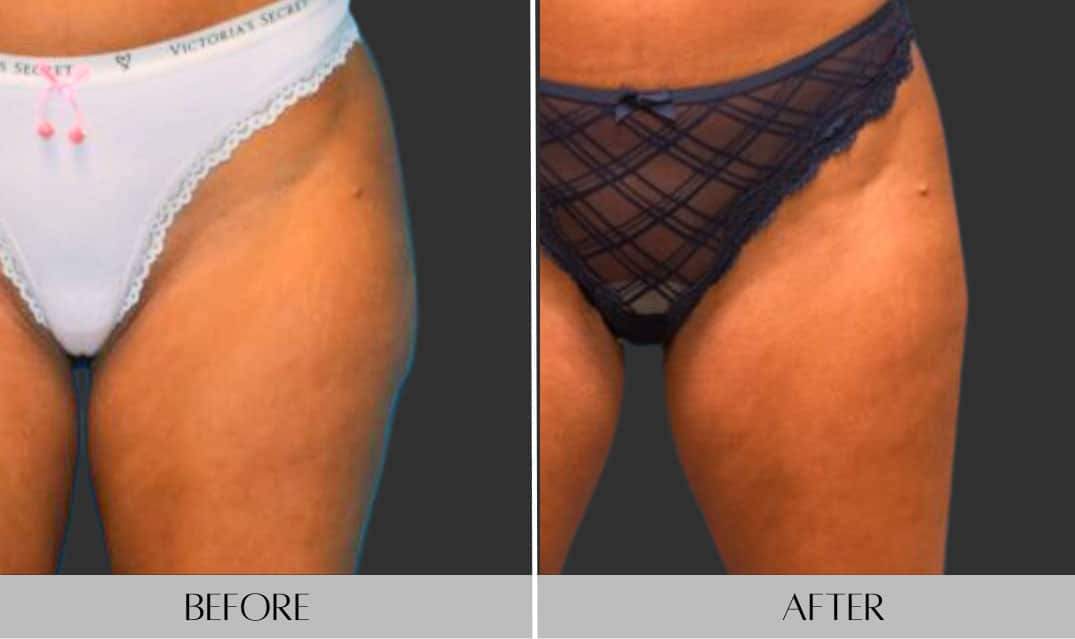 Outer Thigh Liposuction with Smartlipo