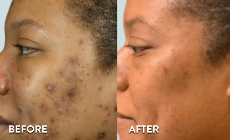 Chemical peels before-after photo