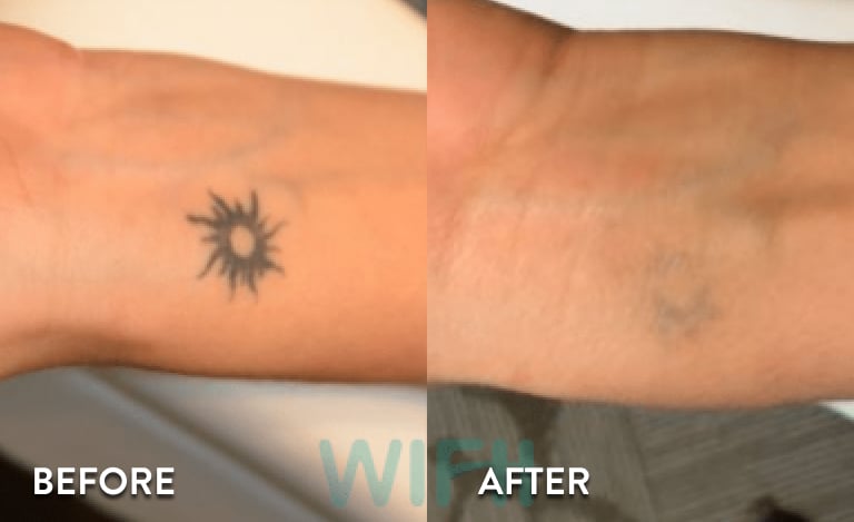 Laser Tattoo Removal Atlanta - Before and After Photos