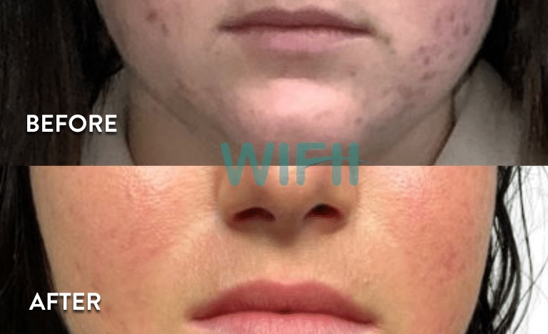 Chemical Peel Results Photos