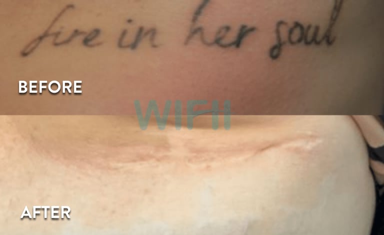 Laser Tattoo Removal Atlanta - Before and After Photos