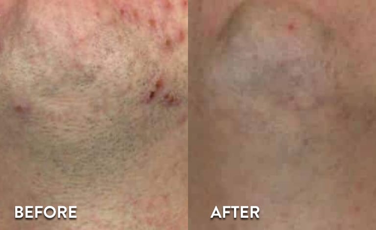 chin-laser-hair-removal-atlanta