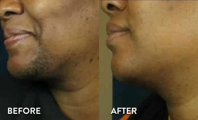 Chin Laser hair Removal - Before and After photos