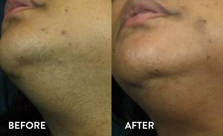 Face Laser Hair Removal Atlanta - Before and After Photos