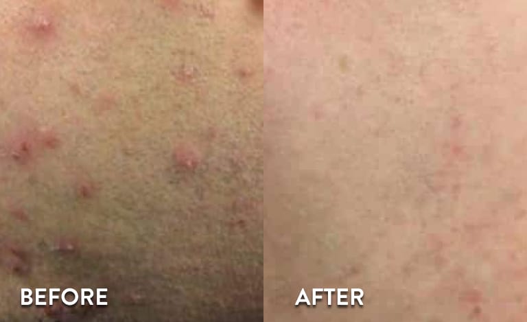 Face Laser Hair Removal Atlanta - Before and After Photos