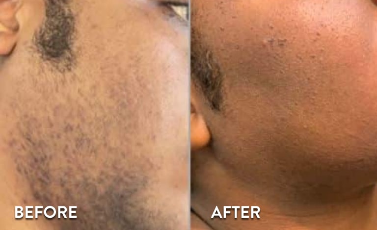 Face Laser Hair Removal Atlanta - Before and After Photos