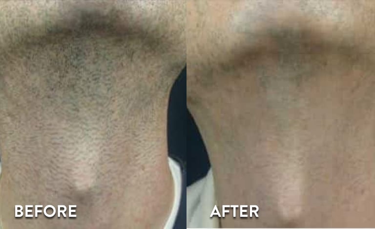 Neck Laser Hair Removal Atlanta - Before and After Photos