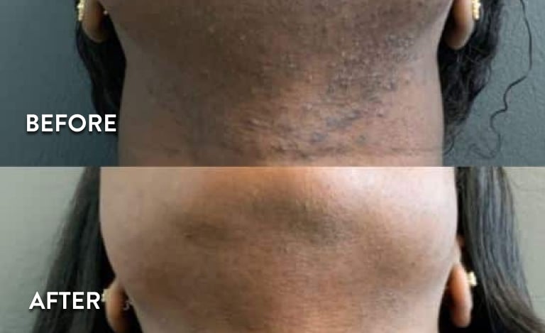 Neck Laser Hair Removal Atlanta - Before and After Photos