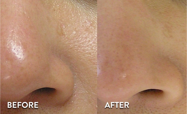 Large Pores- Dull & Dry Skin 2