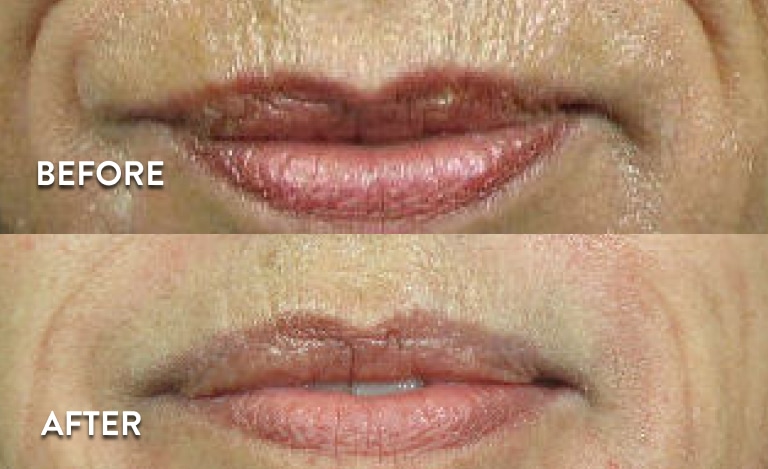 Juvederm XC Before & After Pictures