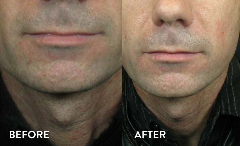 Juvederm XC Before & After Pictures
