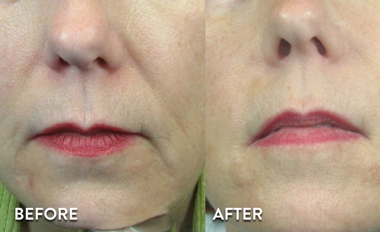 juvederm-xc-before-after-5