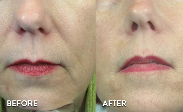 Juvederm XC Before & After Pictures 2
