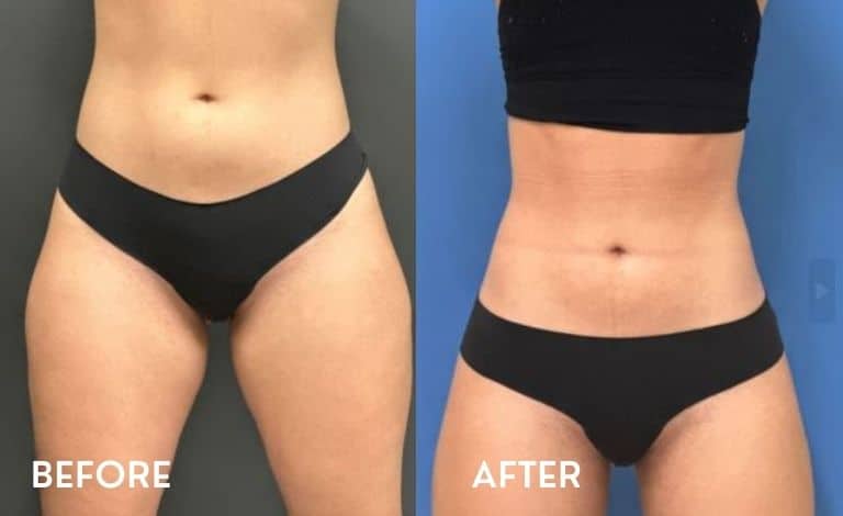 Getting Smartlipo in Atlanta - Before and After Photos Abdomen & Inner Thighs