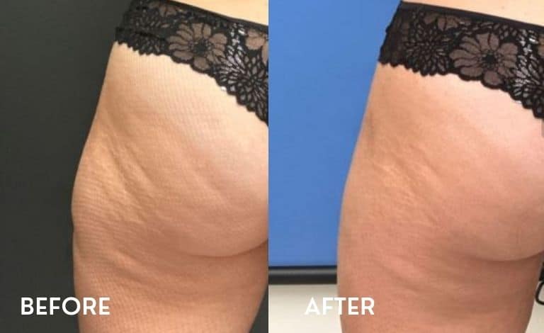 Smartlipo for outer thighs - Before and After Photos