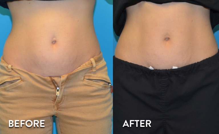 Sculpsure Atlanta Results - Before and After Photos
