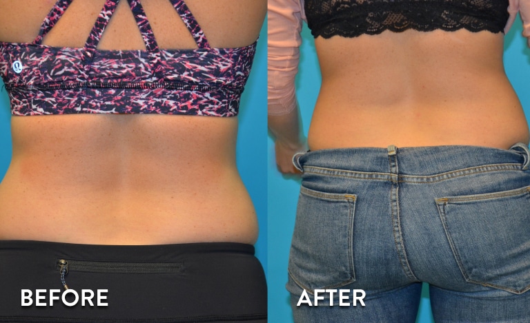 Sculpsure Atlanta Results - Before and After Photos
