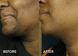 See More Facial Laser Hair Removal Before and After Photos