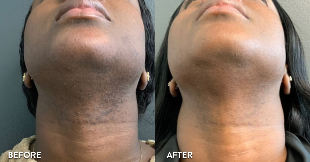 Face & Neck Laser Hair Removal Before and After Photo