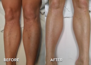 See More Laser Leg Hair Removal Before and After Photos
