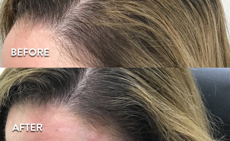 PRP Frontal Hair Loss Treatment Before and After