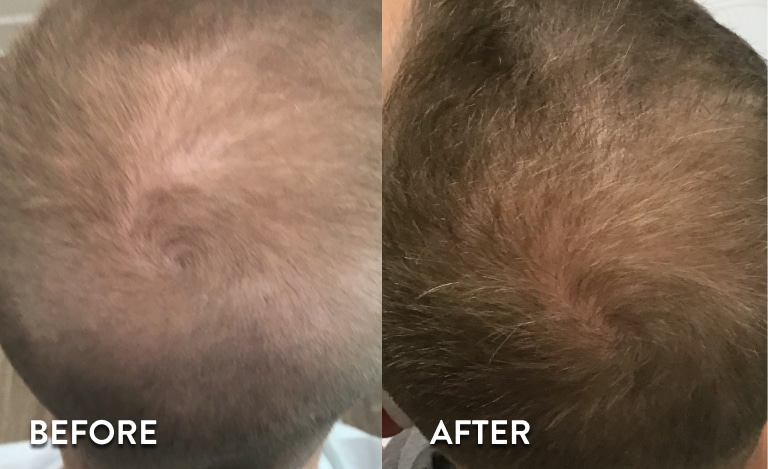 PRP Hair Loss Treatment Before & After
