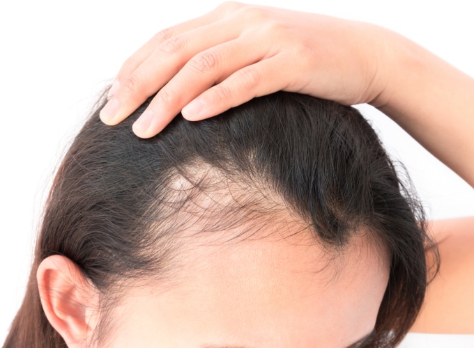 PRP Hair Loss Treatment Recovery & Aftercare