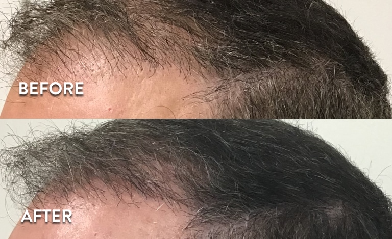 Platelet Rich Plasma Hair Restoration Before and After