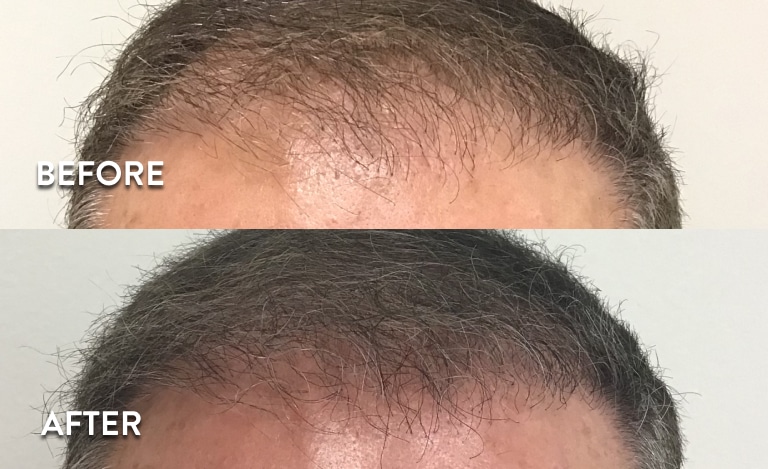 PRP Hair Loss Before and After