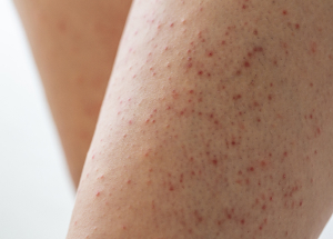 Does Laser Hair Removal Get Rid of Strawberry Legs?