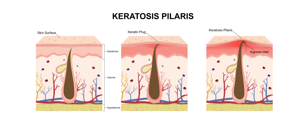 Keratosis Pilaris Strawberry Legs Treatment